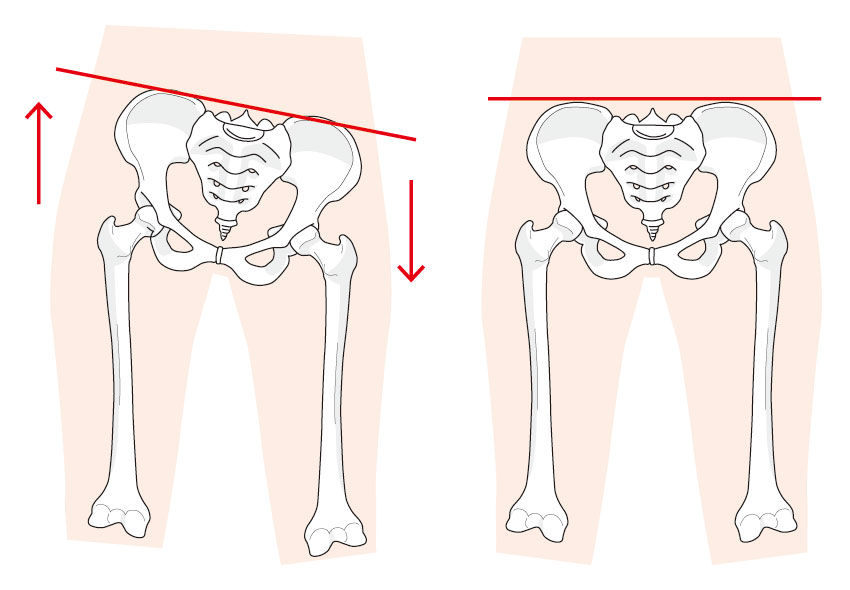 骨盤の左右の傾斜
