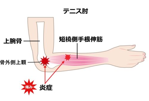 テニス肘