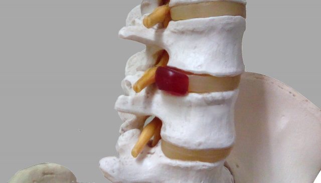 腰椎椎間板ヘルニアの模型図